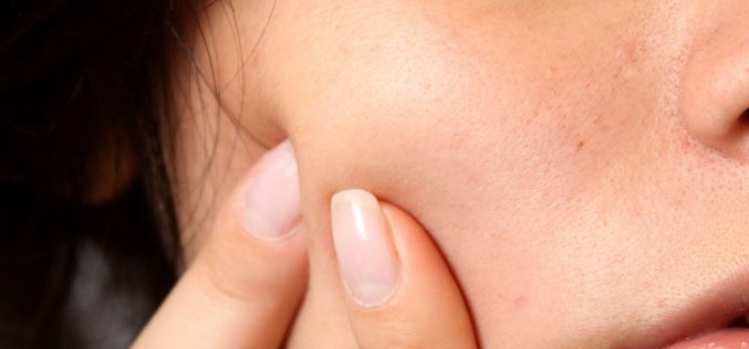 Perché viene l’acne? Si può curare?